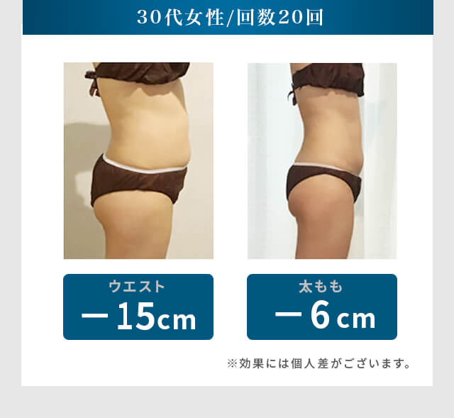 30代女性 / 回数20回 ウエスト -15cm 太もも -6cm