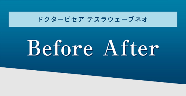 ドクタービセアテスラウェーブネオ Before After